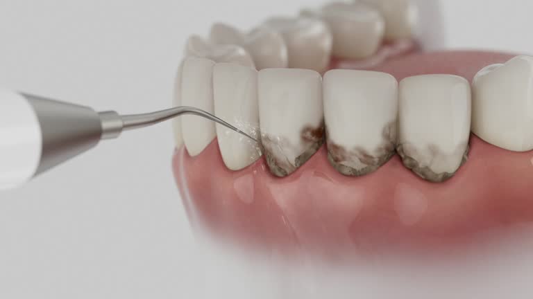 Trusted Wisdom Tooth Removal service in Stratford, NJ - Dentist Open Now